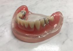 Gedeeltelijke prothese Tandprothetische praktijk van den Eerenbeemt te Deurne Gedeeltelijke prothese Tandprothetische praktijk van den Eerenbeemt te Deurne